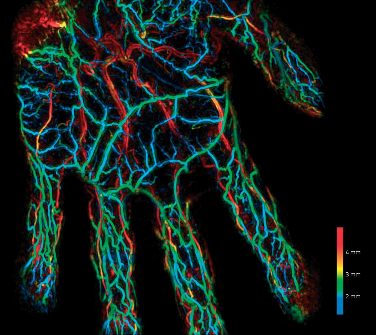 Photoacoustic image of blood vessels in a human palm. The colour scale shows the depth of individual vessels.